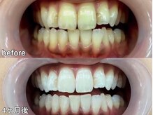 グラーティア 奈良王寺店/ホワイトニング★4ヶ月目★