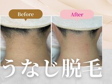フェルナ 上新庄店(FERNA)/うなじ脱毛