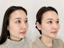 カドモリ 心斎橋(KADOMORI)/小顔矯正×美容鍼5回【美容鍼】