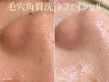 ハティア(hattia)/ニョキニョキ出てくる角栓退治！