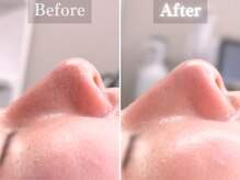 ボーンオム(Born Homme)/毛穴洗浄＋美容液導入：10代女性