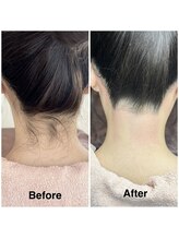 シーズン(Season)/うなじシュガーリング脱毛