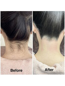 シーズン(Season)/うなじシュガーリング脱毛