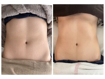 キレイバスト(Kireiii Bust)/ビフォーアフター