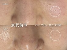 コウル 川西能勢口店(geoul)/肌質改善コース