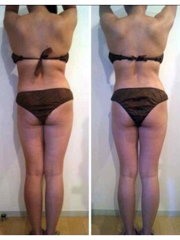 肌屋(HADA-YA)/プロボディで脂肪デトックス