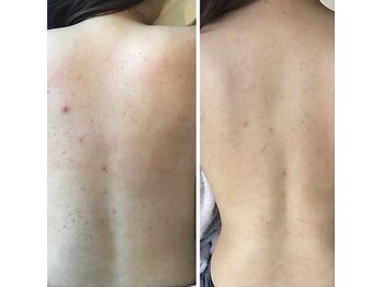 ユニック(unic)/背中カーボキシー1ヶ月