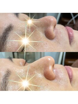 トータルエステサロン エステアンドメイク 錦糸町/ピーリング×光フェイシャル