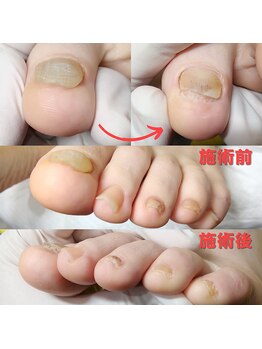 【肥厚・変形爪】ネイル/フット