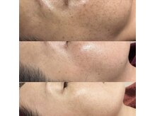 シャルム エスボーテ(charme Esbeaute)/毛穴レス　ハーブピーリング