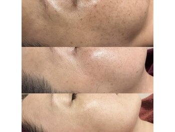 シャルム エスボーテ(charme Esbeaute)/毛穴レス　ハーブピーリング