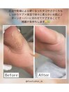 【足裏角質ケア】20代女性
