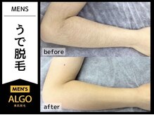 アルゴ 福井店(ALGO)/30代男性 10回目　腕脱毛