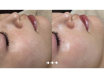 フロラスキン 銀座Blanc店(florasKIN)/肌質改善プログラム