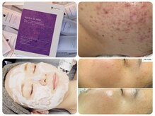 エスボーテ(sbeaute)の雰囲気(プラズマ×高濃度炭酸導入/ニキビ肌/アクネ菌殺菌/くすみ/美白)