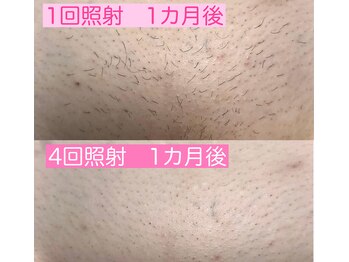 レアマカナ(LeaMakana)/VIO脱毛 介護脱毛