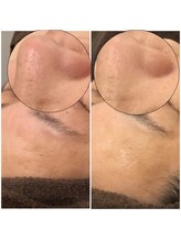 ブローチ 岡崎店(BROOCH)/ハイドラ毛穴洗浄効果大◎