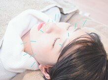 美容鍼でお顔の悩み(くすみ/たるみ/肌荒れなど)にアプローチ◎