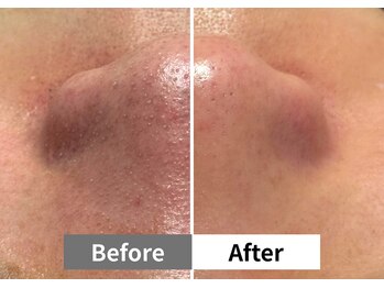 アーキ(ARCHI)/【稲沢/毛穴洗浄】毛穴洗浄