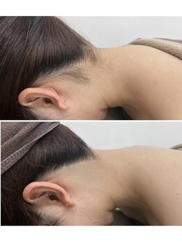 ミース 名古屋駅前店/ ★うなじ脱毛BeforeAfter