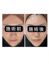 アオヤマ サロン ワイゼット(AOYAMA SALON YZ)/肌印象すっきり