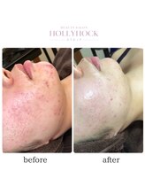 ホリホック/１番人気！陶肌トリートメント