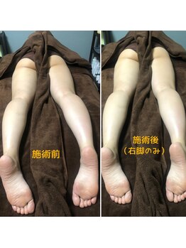 シェノンミュリール(Chainon Murir)/施術前後写真