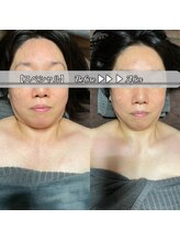 ブラックスワン(Black Swan)/驚異の変貌★小顔矯正　