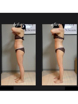エヌボーテ(N. beaute)/before→after全身コース4回目