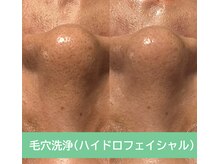 レアマカナ(LeaMakana)/毛穴洗浄(ハイドロフェイシャル)