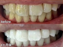 グラーティア 奈良王寺店/ホワイトニング★4ヶ月目★