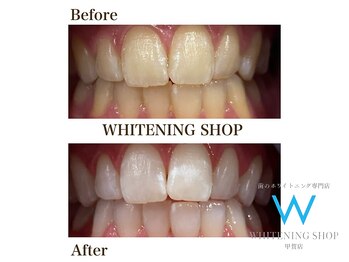 ホワイトニングショップ 甲賀店/Before&After『ホワイトニング』