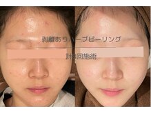 ライフサロン 恵比寿(Life Salon)/ニキビ