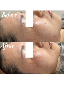 コリー(Kolly)/シミケア直後！！