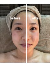 ニコリ(NICOLI)/フェイシャルビフォーアフター