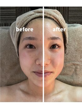 ニコリ(NICOLI)/フェイシャルビフォーアフター