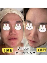 アムール(Amour)/ハーブピリング