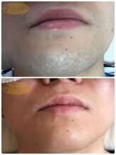 アン リオン(UN LiON)/顔全体12回