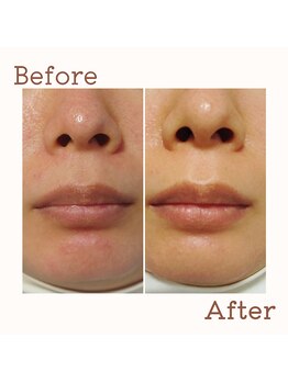 ルポ(repos)/HAAB基礎化粧品で肌質改善