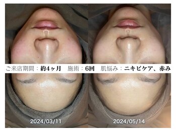 お顔ラボ AOYAMA(お顔LABO)/スキングローピール6回のお客様