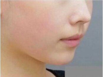 ベル(belle)/施術イメージ