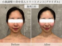 フラリ 西葛西(Hulali)/【20代】顔＋背中ブライダルケア