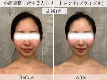 フラリ 西葛西(Hulali)/【20代】顔+背中ブライダルケア