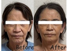 ユニ(Uni)/60代人気No1高周波・リジェセル