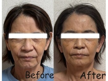 ユニ(Uni)/60代人気No1高周波・リジェセル