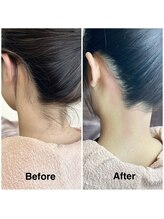 シーズン(Season)/うなじシュガーリング脱毛