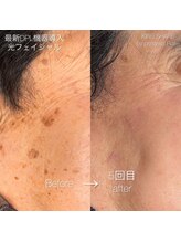 プリンセスローズ 焼津店(Princess Rose)/光フェイシャル