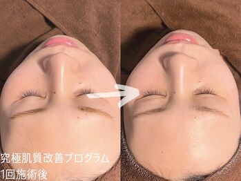 ルーナジェーナ(Luna llena)/究極の肌質改善プログラム