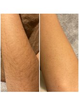 ボンダイボディー(Bondi Body)/キッズ脱毛