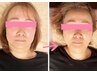 【プレミアム小顔】小顔造形+肌活性化コラーゲン生成BBL光フェイシャル照射